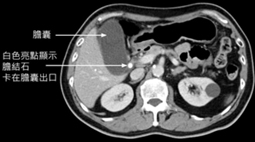 好「膽」嘜走  談膽結石與膽囊炎(相關圖片)