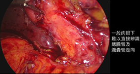 好「膽」嘜走  談膽結石與膽囊炎(相關圖片)
