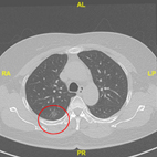 預防篩檢戰勝新國病-肺癌(相關圖片)