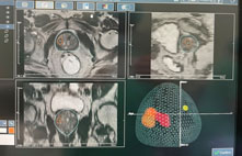 攝護腺癌診斷新利器  核磁共振超音波影像融合攝護腺切片(相關圖片)