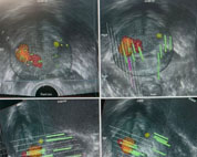 攝護腺癌診斷新利器  核磁共振超音波影像融合攝護腺切片(相關圖片)