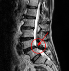腰椎滑脫合併坐骨神經痛的手術新選擇   單創口微創腰椎神經減壓與皮質骨釘固定融合手術(相關圖片)