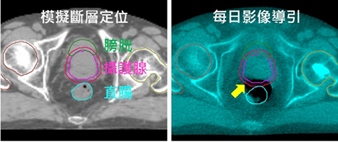 超短療程放射治療  攝護腺癌快速、安全、有效之選擇(相關圖片)