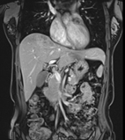 磁振造影(MRI)在全身癌症檢查的應用(相關圖片)