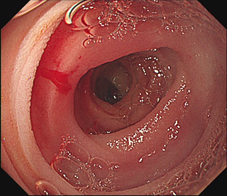 探索腸道奧秘    膠囊內視鏡檢測技術(相關圖片)