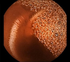 探索腸道奧秘    膠囊內視鏡檢測技術(相關圖片)