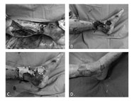 傷口重建新選擇    談人工真皮應用(相關圖片)
