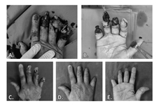 傷口重建新選擇    談人工真皮應用(相關圖片)