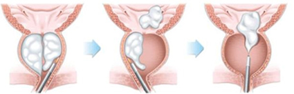 良性攝護腺肥大  新型微創手術治療方式(相關圖片)
