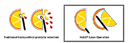良性攝護腺肥大  新型微創手術治療方式(相關圖片)