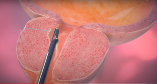 良性攝護腺肥大  新型微創手術治療方式(相關圖片)