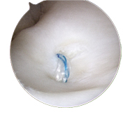 三角纖維軟骨複合體損傷  腕關節鏡微創手術助復原(相關圖片)