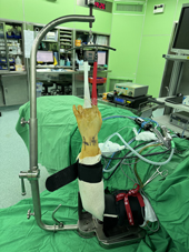 三角纖維軟骨複合體損傷  腕關節鏡微創手術助復原(相關圖片)