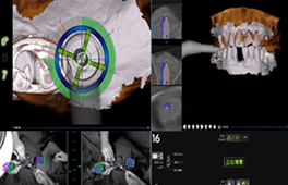 電腦影像模擬合併導航系統    有效提高手術效率和精確度(相關圖片)