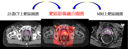 SBRT立體放射治療高效能、高精準、副作用少(相關圖片)