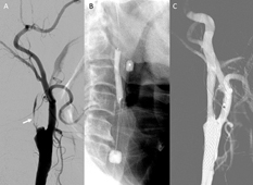 「微創血管介入治療」 遠離神經血管疾病的傷害  (相關圖片)