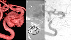 「微創血管介入治療」 遠離神經血管疾病的傷害  (相關圖片)