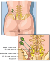 痠、麻、痛的另一種治療選擇    談高頻熱凝神經阻斷術/射頻脈衝式神經調控(相關圖片)