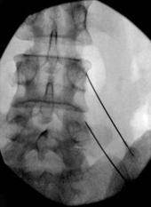 痠、麻、痛的另一種治療選擇    談高頻熱凝神經阻斷術/射頻脈衝式神經調控(相關圖片)
