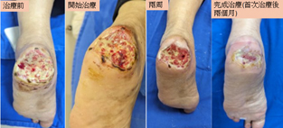 困難傷口治療的創新契機  細胞治療(相關圖片)