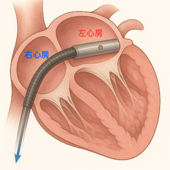 LAVA ECMO  為心因性休克患者撐起希望之傘(相關圖片)