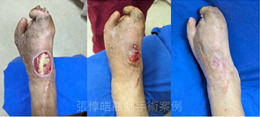 告別糖尿病足 整合治療、新藥與再生醫學(相關圖片)