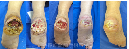 告別糖尿病足 整合治療、新藥與再生醫學(相關圖片)