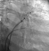 左心耳封堵手術  預防中風的關鍵武器(相關圖片)