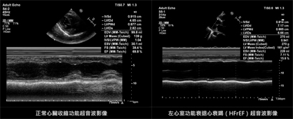 守護心臟  新治療戰勝心衰竭(相關圖片)