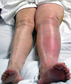 深層靜脈血栓  血管內的隱形威脅(相關圖片)