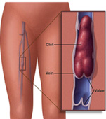 深層靜脈血栓  血管內的隱形威脅(相關圖片)