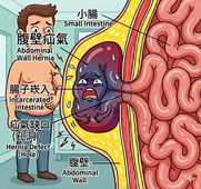 顛覆您的認知    關於「疝氣」應了解的四個醫學真相(相關圖片)