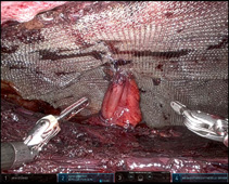 顛覆您的認知    關於「疝氣」應了解的四個醫學真相(相關圖片)