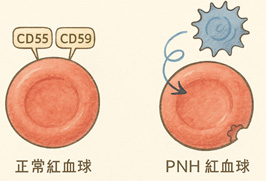 當免疫系統誤傷自己   認識罕見血液疾病「陣發性夜間血紅素尿症」(相關圖片)