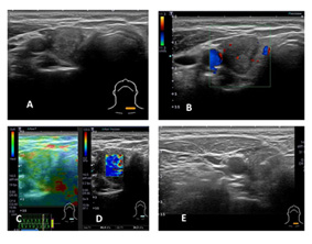 創新副甲狀腺偵測技術  引領甲狀腺手術新時代(相關圖片)