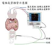創新副甲狀腺偵測技術  引領甲狀腺手術新時代(相關圖片)