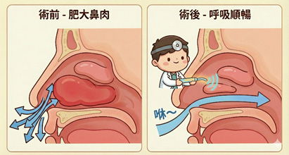 惱人的噴嚏打不停？  全方位解析「過敏性鼻炎」(相關圖片)