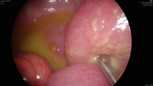 「媽媽，我肚子痛！」別輕忽　小兒腹痛恐藏外科急症(相關圖片)