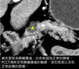 切片薄至0.2毫米！ 光子計數電腦斷層(PCCT) 看清微小病灶的高精準診斷技術(相關圖片)