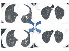 『免疫治療』 讓病患有機會與癌症末期和平共處(相關圖片)