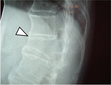 腰痠背痛』  一定是僵直性脊椎炎嗎？(相關圖片)
