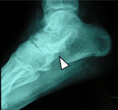 腰痠背痛』  一定是僵直性脊椎炎嗎？(相關圖片)