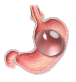 減重效果不彰又不想外科手術   『胃鏡減重術』就能搞定 (相關圖片)