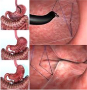 減重效果不彰又不想外科手術   『胃鏡減重術』就能搞定 (相關圖片)