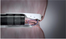 減重效果不彰又不想外科手術   『胃鏡減重術』就能搞定 (相關圖片)