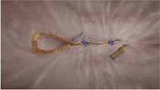 減重效果不彰又不想外科手術   『胃鏡減重術』就能搞定 (相關圖片)