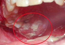 不可不知的危害  談『口腔癌與檳榔』之間關係(相關圖片)