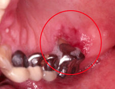 不可不知的危害  談『口腔癌與檳榔』之間關係(相關圖片)