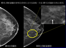 提早發現乳癌的最新利器  『3D乳房斷層攝影』(相關圖片)