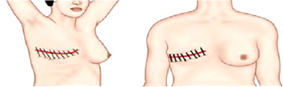 乳癌手術不留疤 『3D內視鏡微創』手術(相關圖片)